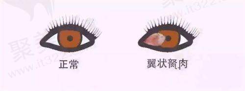 青光眼手术价格一览