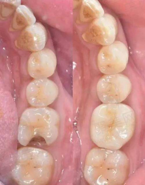 避免深龋后补牙的误解
