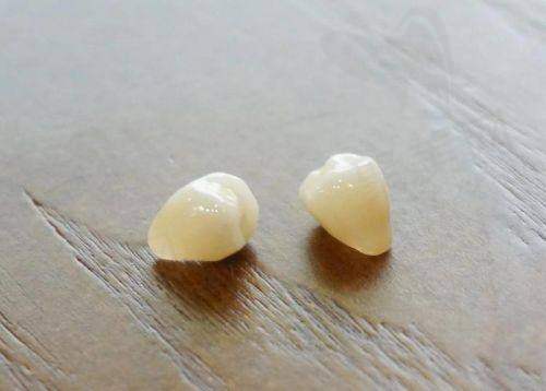 威兰德和泽康哪个好？威兰德与泽康全瓷牙冠对比分析：选择哪种更适合后牙及前牙修复？