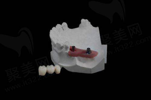 老人假牙价目表：特殊类型假牙价格