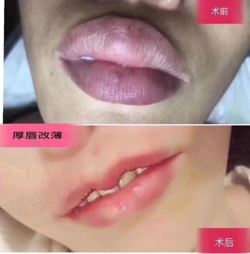 埋线减肥适合哪些人？埋线减肥的适合人群与效果解析，助你安全有效减重，塑造理想身材