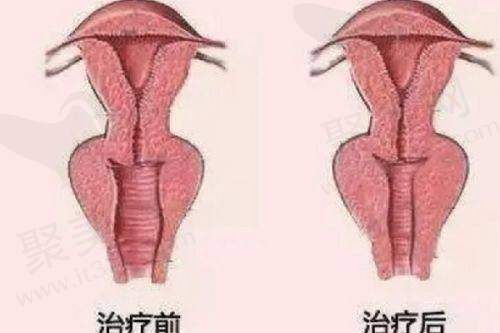 抽全身脂肪20斤多少钱的实际实例分析