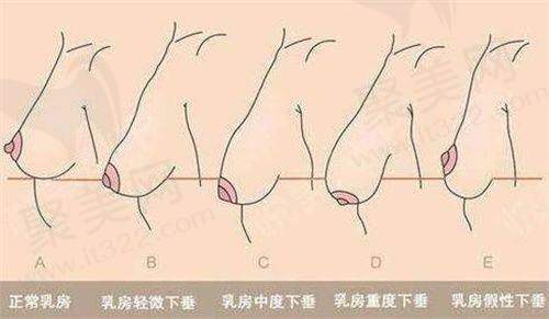 太阳凹陷填充什么更好？