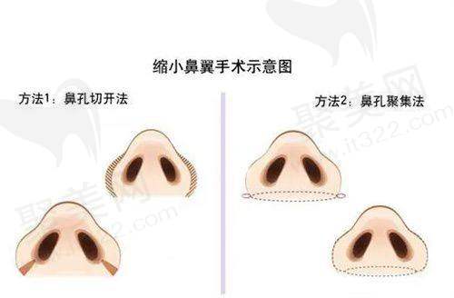 饮食调整是内脏脂肪消除更快的方法
