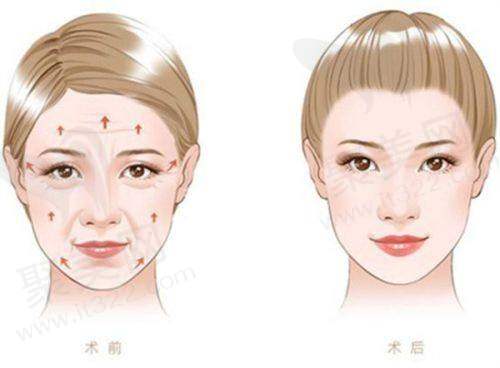 抽脂大腿多少钱？抽脂大腿手术费用解析：2025年价格范围及性价比全面分析，大腿吸脂手术费用大约在40000元起