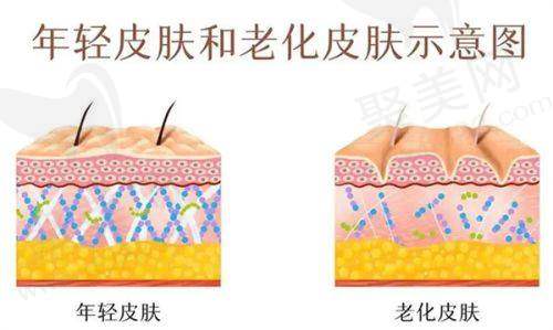 玻尿酸填充的优势