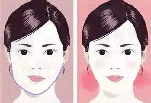 打咬肌瘦脸针的副作用