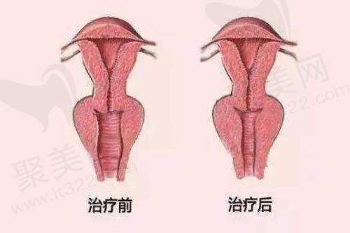 埋线减肥适合重视整体调理的人群