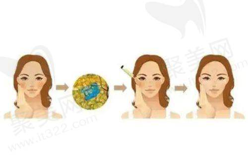 脸上打轻薄是不是溶脂针？轻薄针与溶脂针对比：如何解决馒化脸问题，变薄脸部更美丽？