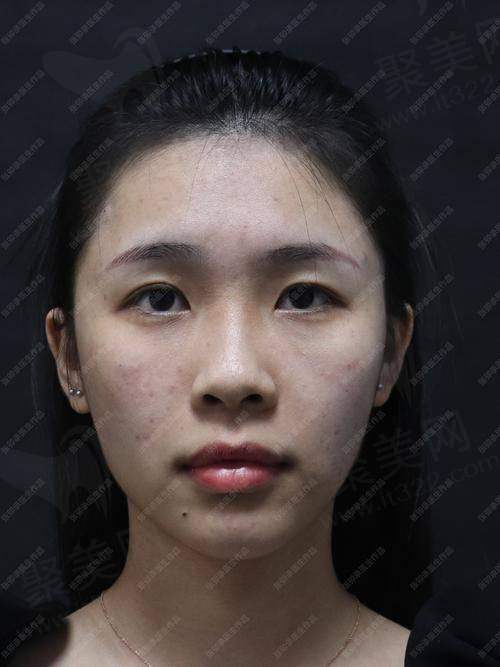 幼态脸能保持多久？幼态脸打造7天见效，维持时间可达3年以上，塑造年轻自然面容的秘诀解析