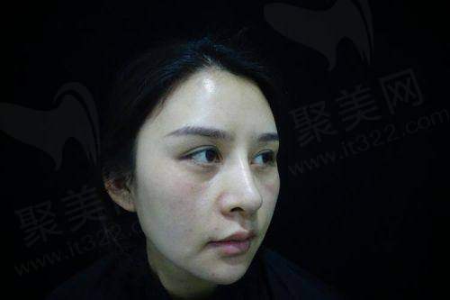 上海首尔丽格弗缦胶原蛋白泪沟填充成效维持时间