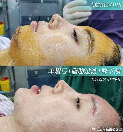 重庆星荣整形外科医院脂肪胶填充眉弓原价23800元，优惠价12800元起享高品质医美体验