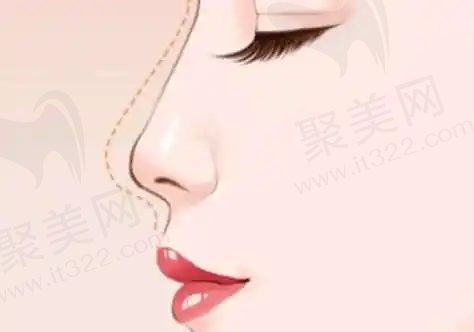 腋下黑色素怎么去除？腋下黑色素沉着去除方法与效果解析，激光治疗小妙招分享，助你恢复亮白肌肤！