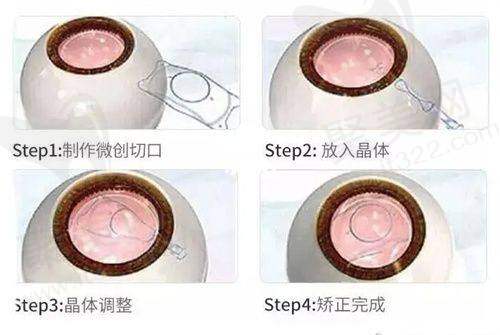石家庄复明眼科医院半飞秒手术的技术优势
