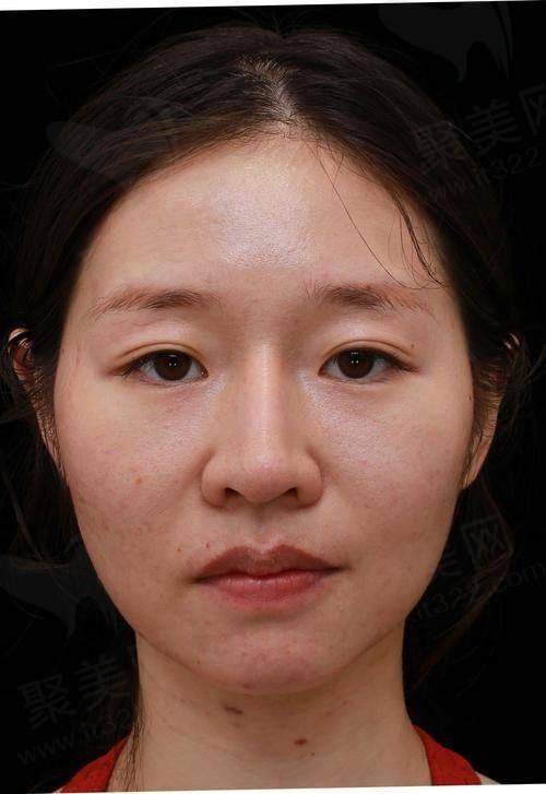 六、尿酸多少算高尿酸之应对措施