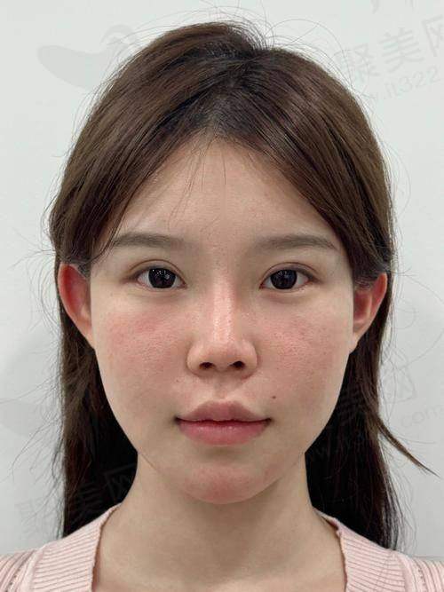 一、尿酸多少算高尿酸之正常范围