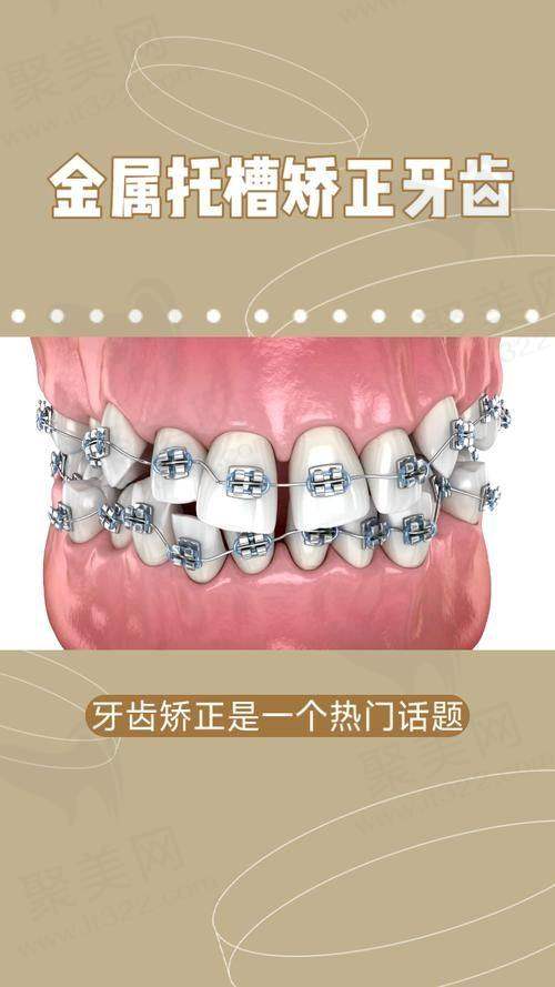 宁波牙博士口腔国产直丝弓金属托槽原价8299元，折扣价格5680元起性价比超高！