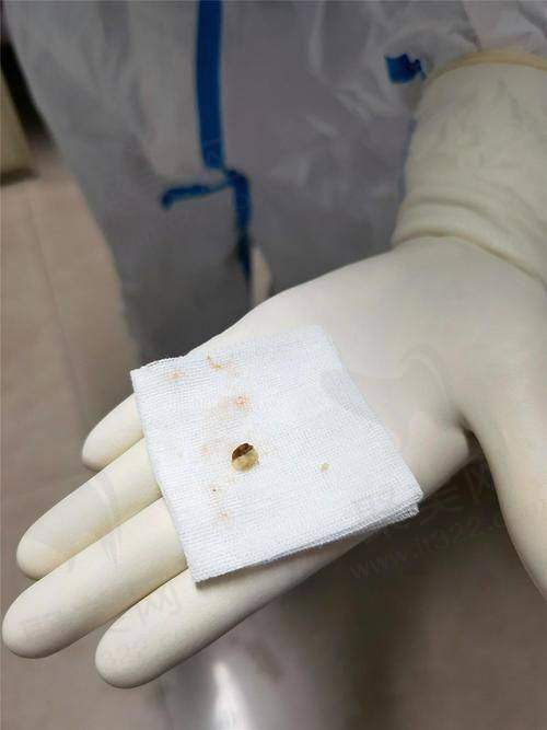 广州荔湾医院取奥美定是真的