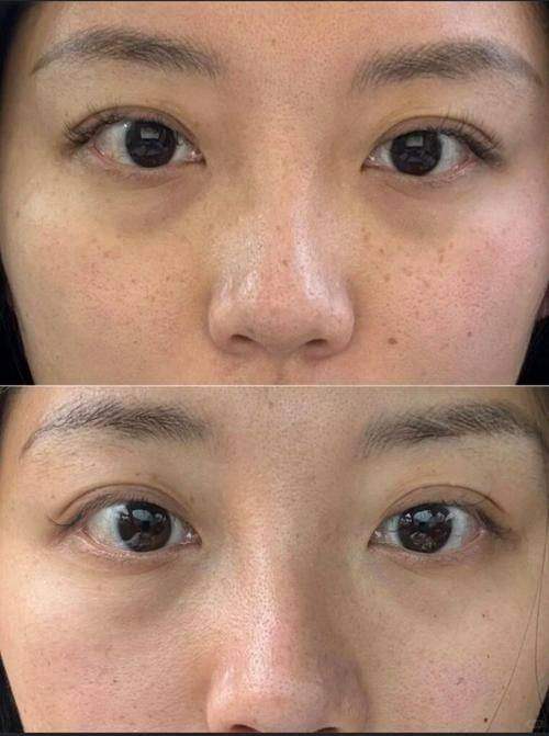 上海华美超皮秒祛斑的未来发展趋势