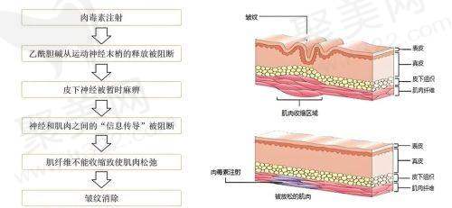 深圳鹏爱秀琪李莉操刀乔雅登雅致玻尿酸幼态脸仅1810元起，塑造精致减龄面容