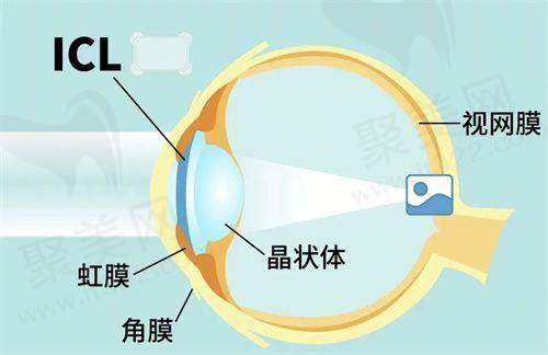 临沂新益民眼科医院全飞秒15800元起，切口小恢复快，中低度近视矫正优选