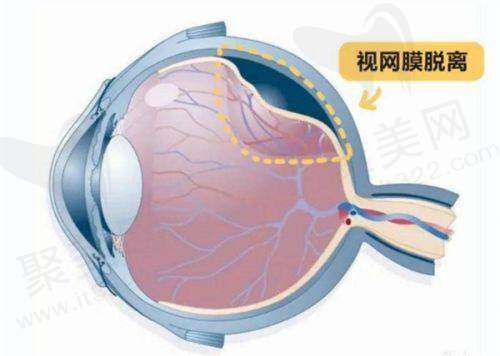 斜视手术价格范围