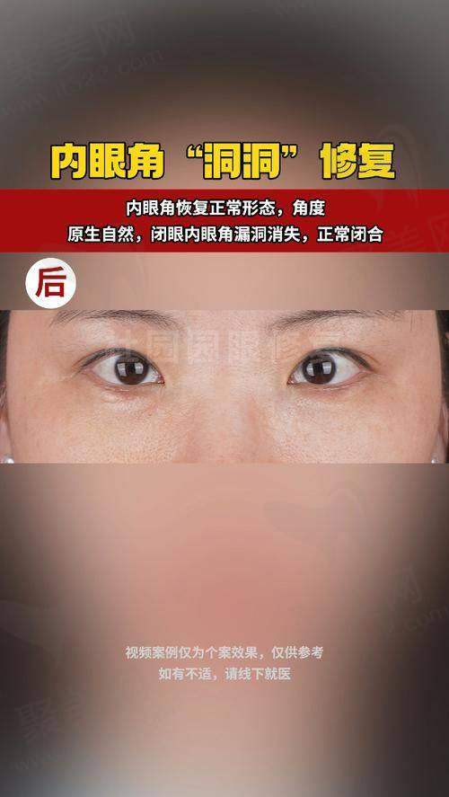 高寿松修复双眼皮成效显著