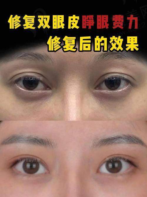 高寿松修复双眼皮个性化方案