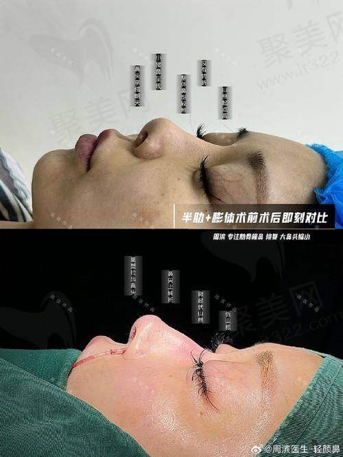 成都周柯做修复鼻怎么样——真实成功实例分享