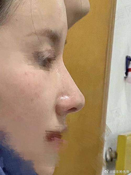 成都周柯做修复鼻怎么样——丰富的经验与技术