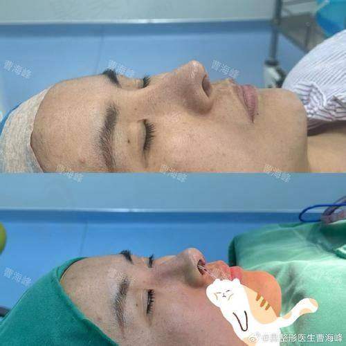 结尾总结：成都周柯做修复鼻怎么样?