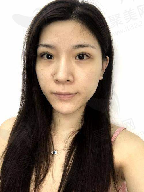 四、胶原蛋白填充泪沟的优势总结