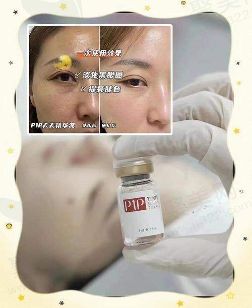 上海首尔丽格冭活泡泡水光+嗨体2.5ml的技术水平