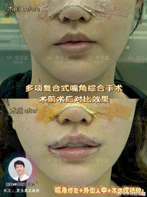 十二、准妈妈必看：预防唇裂的四大神操作