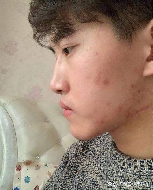 12岁儿童地包天矫正的成效与保护