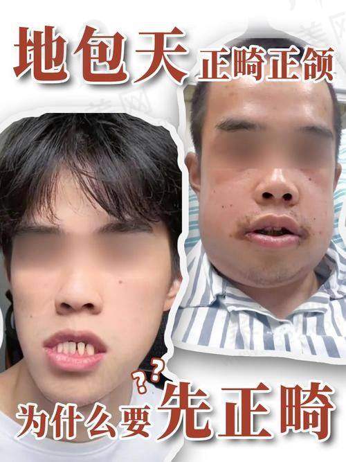 影响12岁地包天牙齿矫正价格的因素