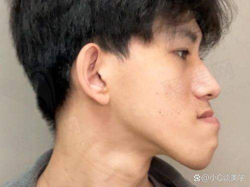 12岁儿童隐形矫正的费用分析