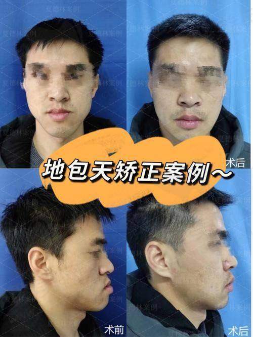 12岁儿童地包天矫正的医院推荐