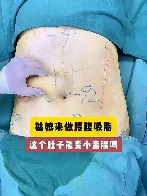 杭州彭涛吸脂医生真实实例靠谱吗？特色技术见真章