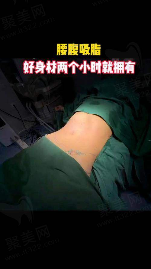 杭州彭涛吸脂医生真实案例靠谱吗？经验技术口碑全在线多案例验证可考虑