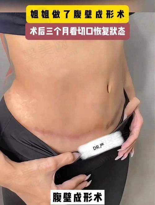 重庆华美曹勇做腹壁整形会有个性化方案吗？