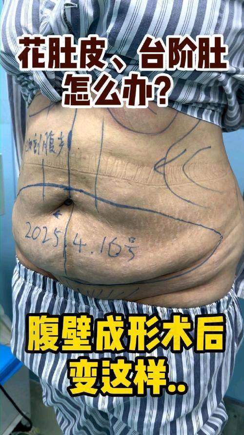 重庆华美曹勇的“联合腹壁整形隆胸术”怎么样？