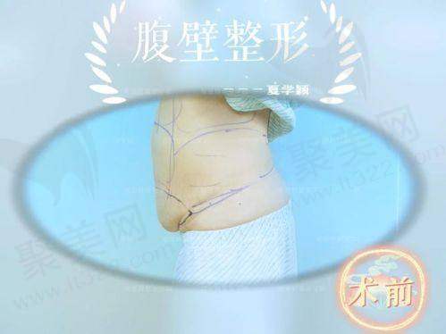 重庆华美曹勇做腹壁整形的实例多吗？口碑怎么样？