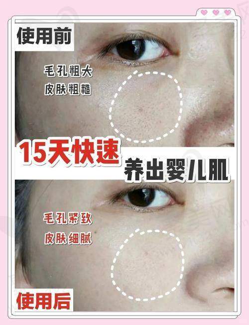 八、关于毛孔粗大激光治疗的常见疑问解答