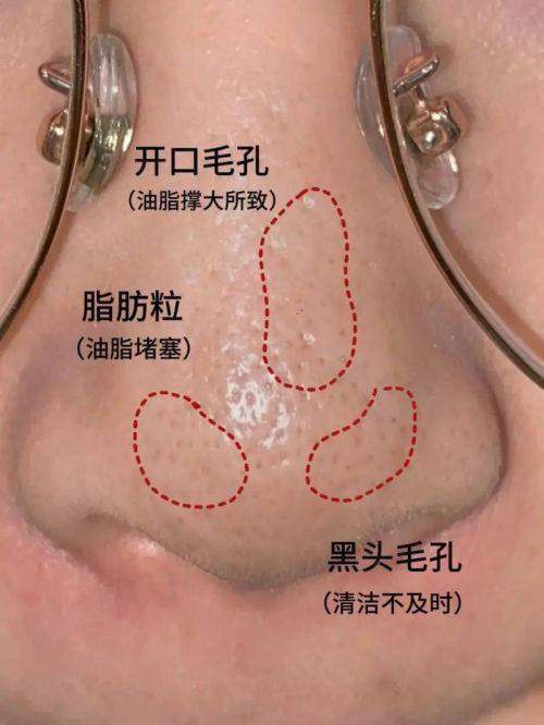 四、毛孔粗大激光治疗的成效