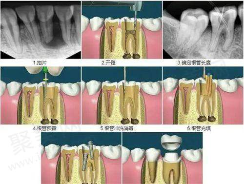 宁波牙博士口腔儿童根管治疗的重要作用