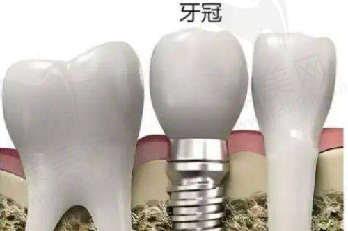 五、影响沈阳种植牙价格的关键因素