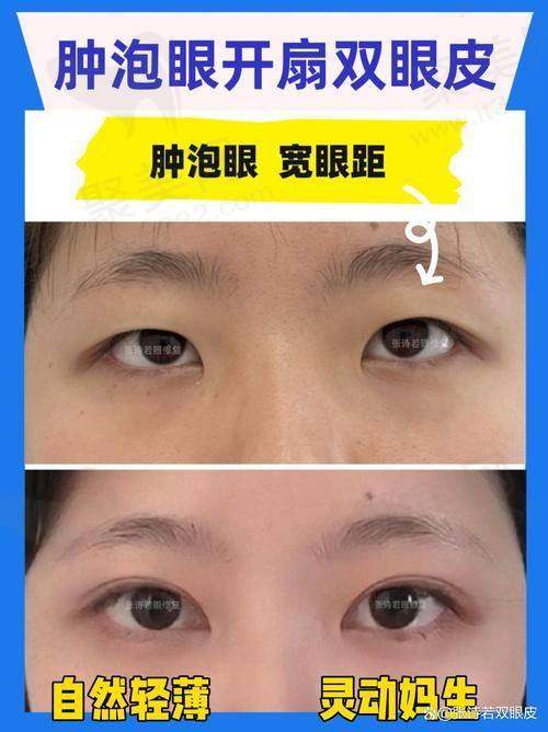 四、影响张诗若双眼皮修复价格的因素
