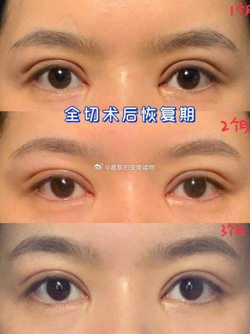 五、王衡健双眼皮修复价格参考