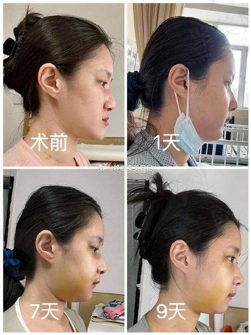 五、选择陈光平医生做鼻子的注意事项